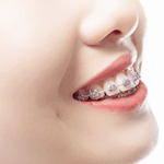 矯正治療の流れと治療中の注意事項について