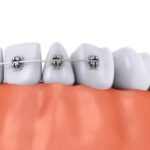 矯正治療は痛い？矯正歯科における痛みについて