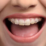 矯正中に役立つ事前知識3選