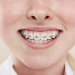 金属アレルギーの方の歯科矯正について解説