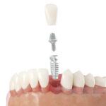 「骨の量が足りない場合、インプラント治療はできないですか？」【後編】