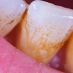 歯に歯石がついている！インビザライン矯正に影響はある？