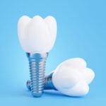 インプラントのデメリット