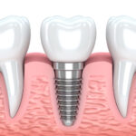 インプラント治療で用いる機器について