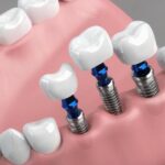 当院のインプラントメーカーについて