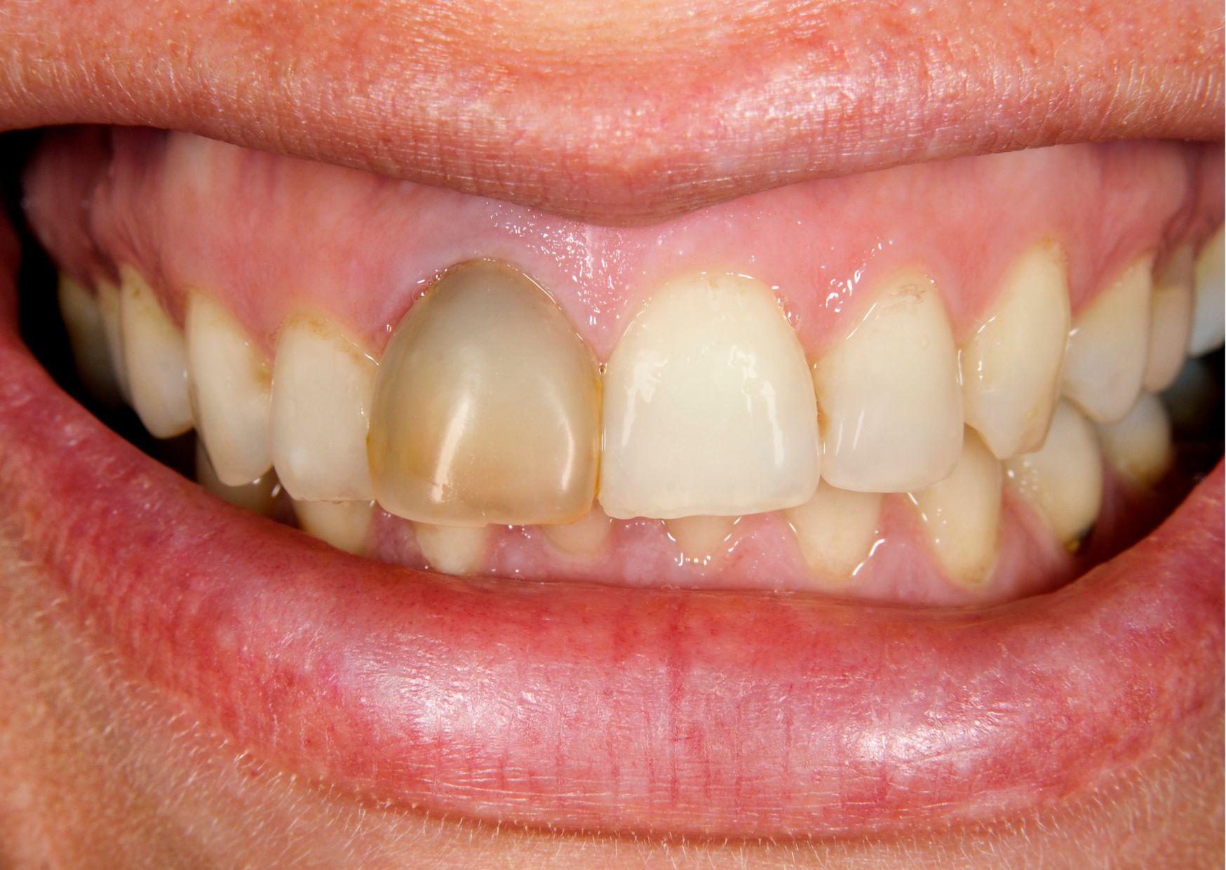 ウォーキングブリーチ（失活歯専用）