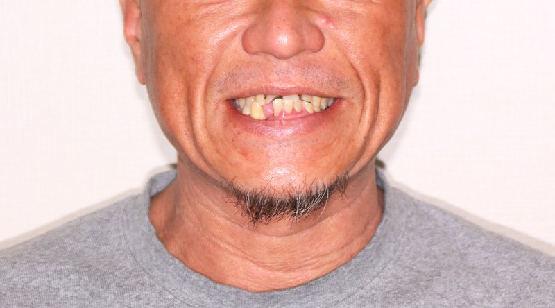 治療前後の口元