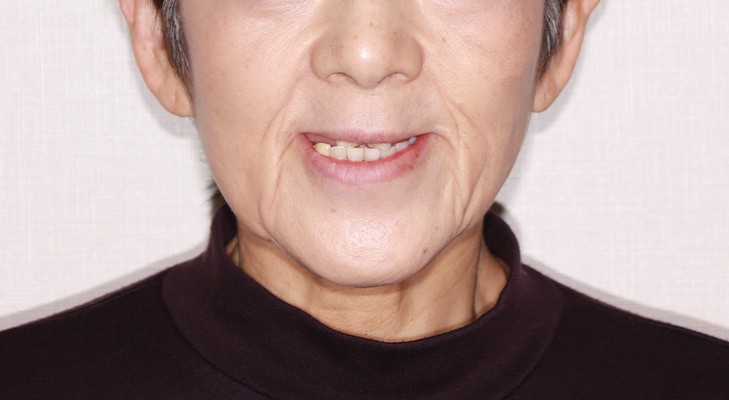 治療前後の口元
