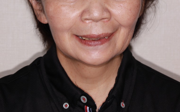 治療前後の口元