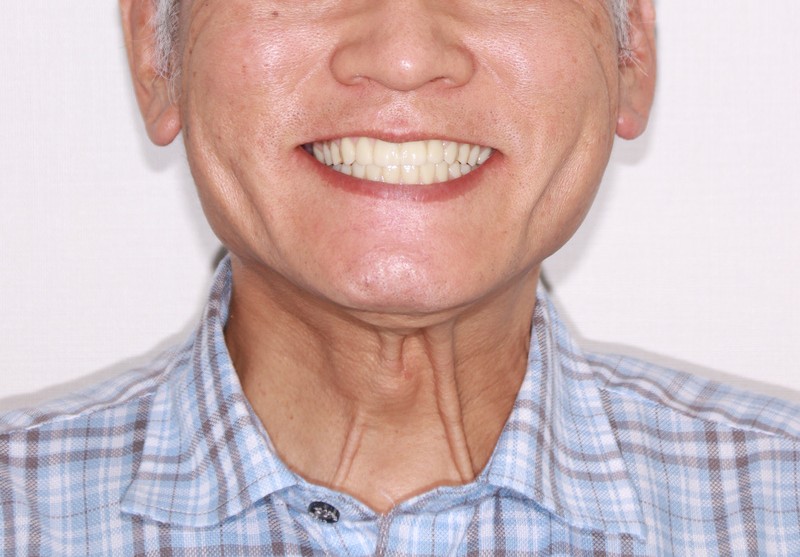 治療前後の口元